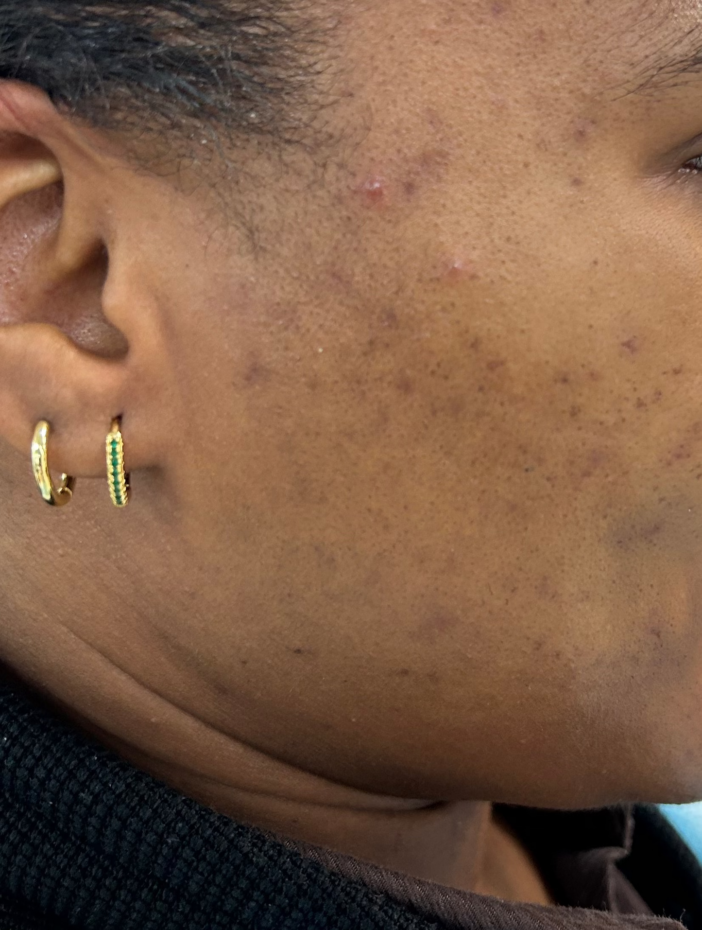 Skin Correction Facial
