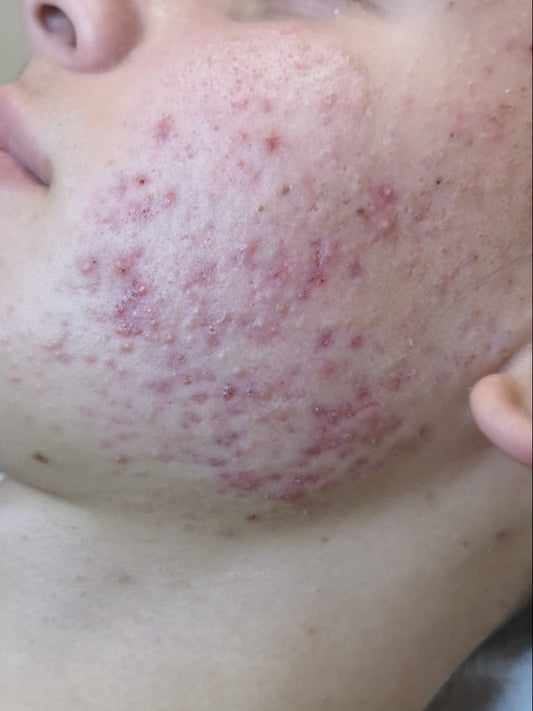 Skin Correction Facial