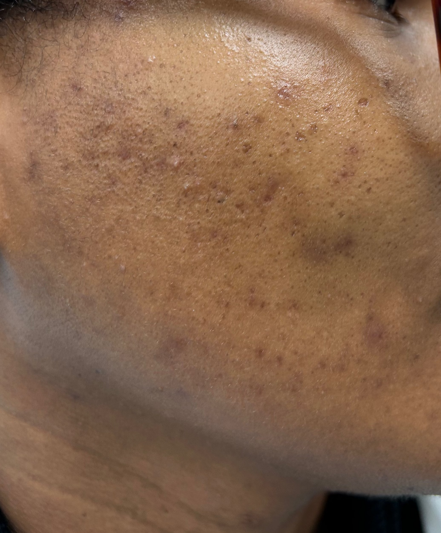 Skin Correction Facial