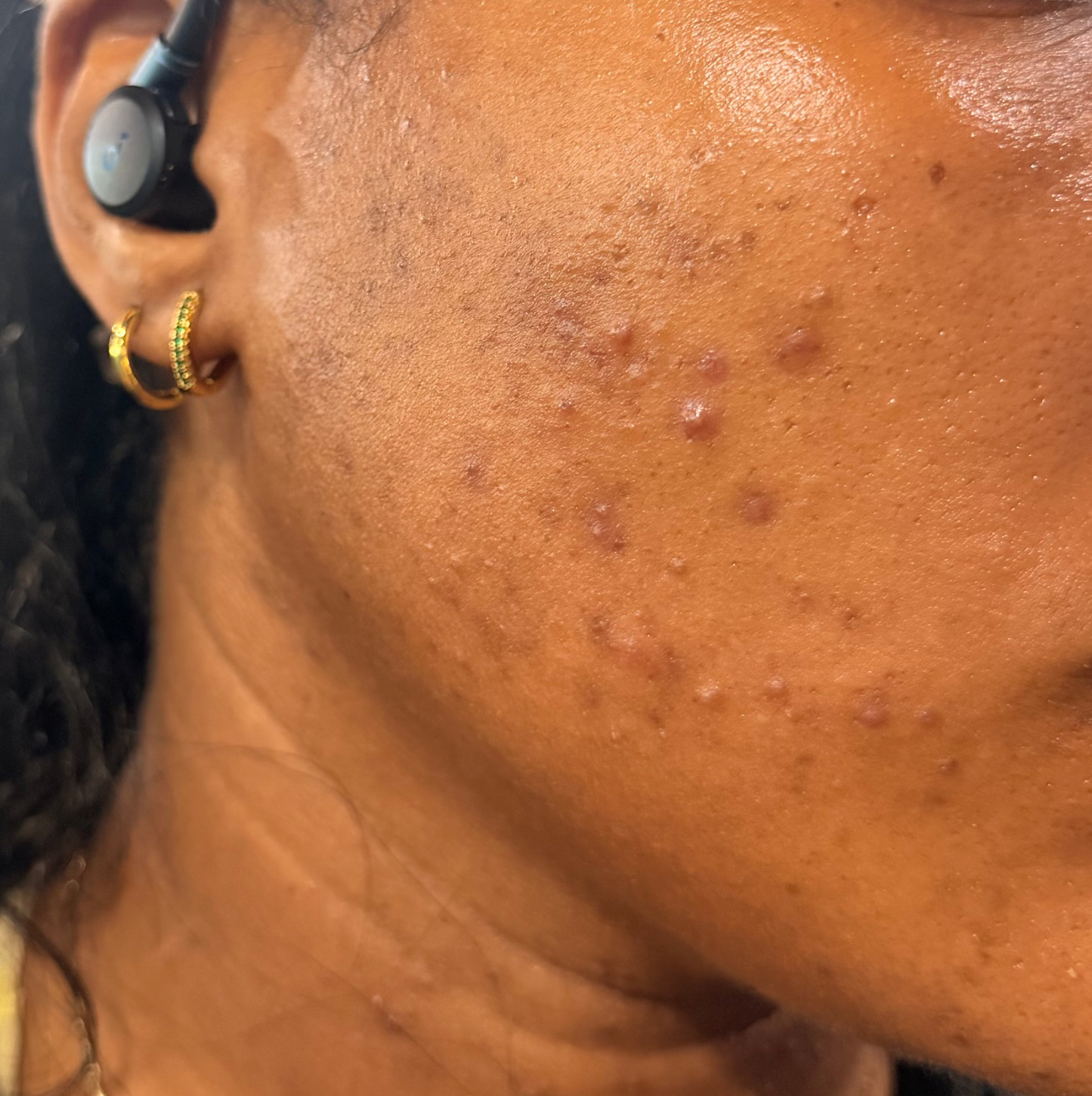 Skin Correction Facial