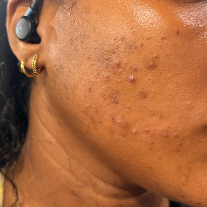 Skin Correction Facial