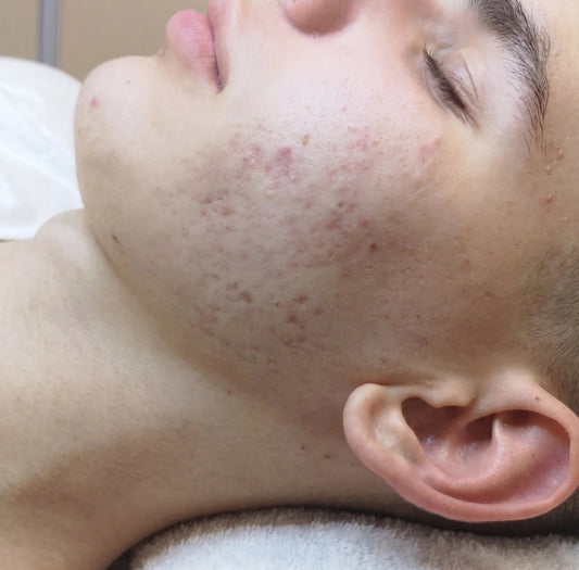 Skin Correction Facial